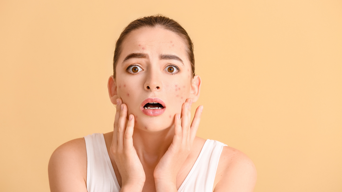 Can Toner Cause Acne?