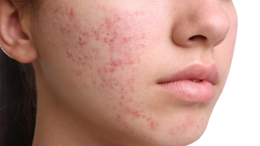 The Best Routine for Acne (Backed by Science!)