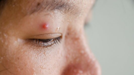 How to Get Rid of Sweat Pimples: Causes, Remedies, and Prevention